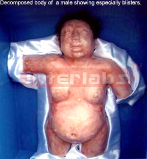   	 Decomposed body of a male showing blisters